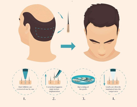 Direct Hair Implant