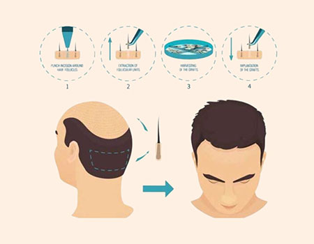 FUE Hair Transplant
