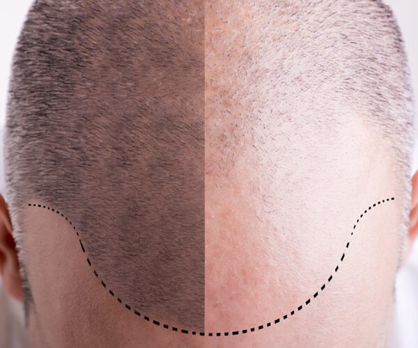 Affordable Hair Transplant Cost in Delhi